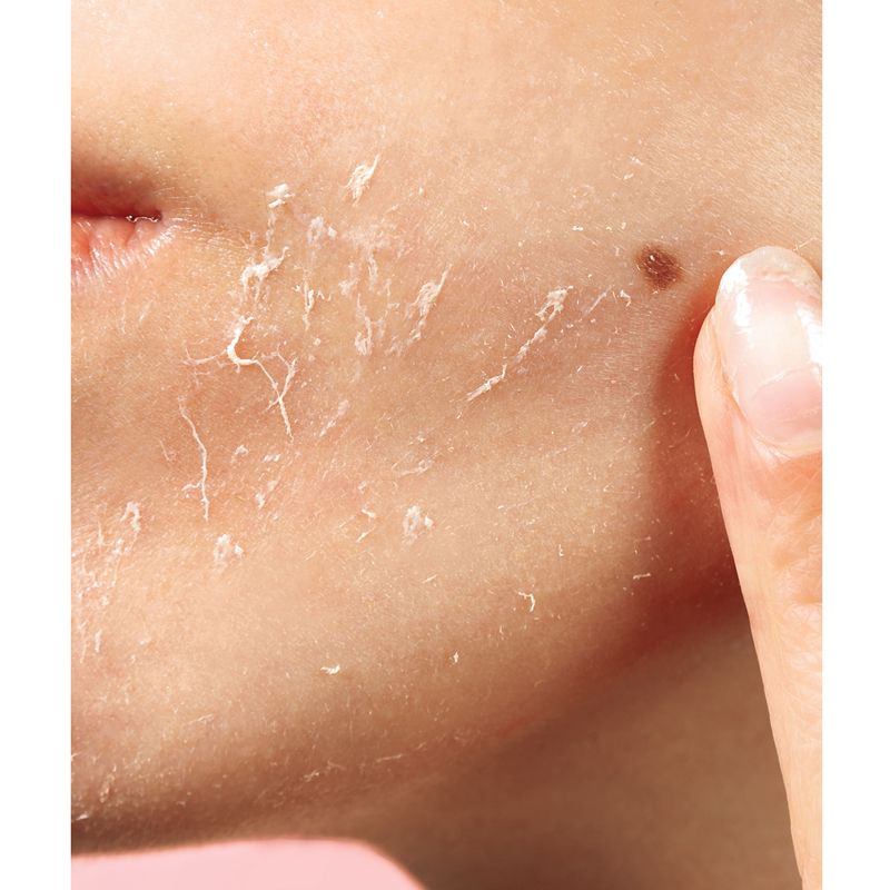 close-up of a woman's peeling face before using this product.