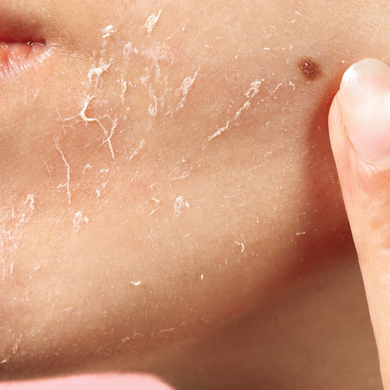 Close-up of a woman&#39;s peeling face of dead skin with use of Odacite Bioactive Rose Gommage