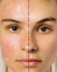 Close up of model's face shown split view with one side of Odacite Bioactive Rose Gommage use showing peeling dead skin, and the other side of the face after use