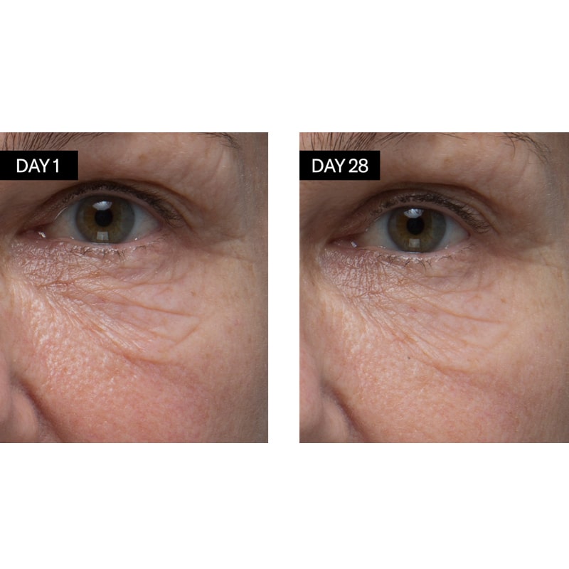 Close up of skin under the eye on Day 1 and Day 28 with use of Odacite Retinol + Hyaluronic Acid Renewing Serum