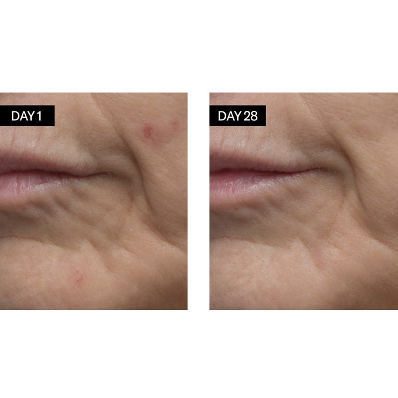 Close up of skin around lips on Day 1 and Day 28 with use of Odacite Retinol + Hyaluronic Acid Renewing Serum