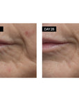 Close up of skin around lips on Day 1 and Day 28 with use of Odacite Retinol + Hyaluronic Acid Renewing Serum