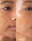 Furtuna Skin Triple Active Exfoliator - Before and after photos