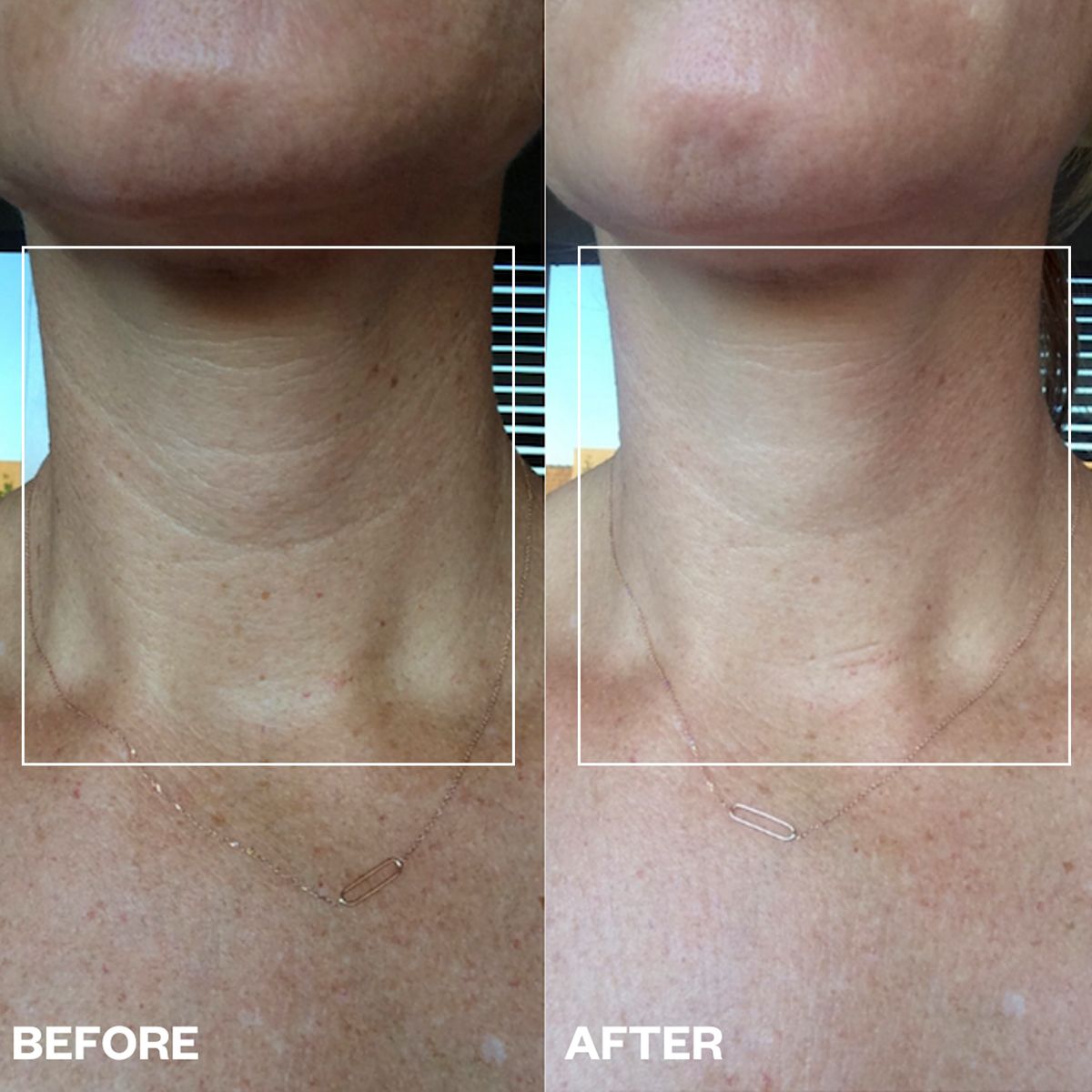 Wrinkles Schminkles Neck Wrinkle Patch (1 pc)  - product before and afters shown. 