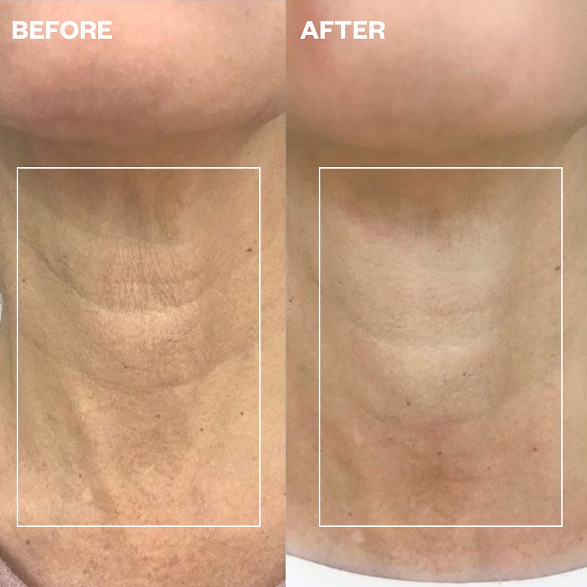 Wrinkles Schminkles Neck Wrinkle Patch (1 pc)  - product before and afters shown. 