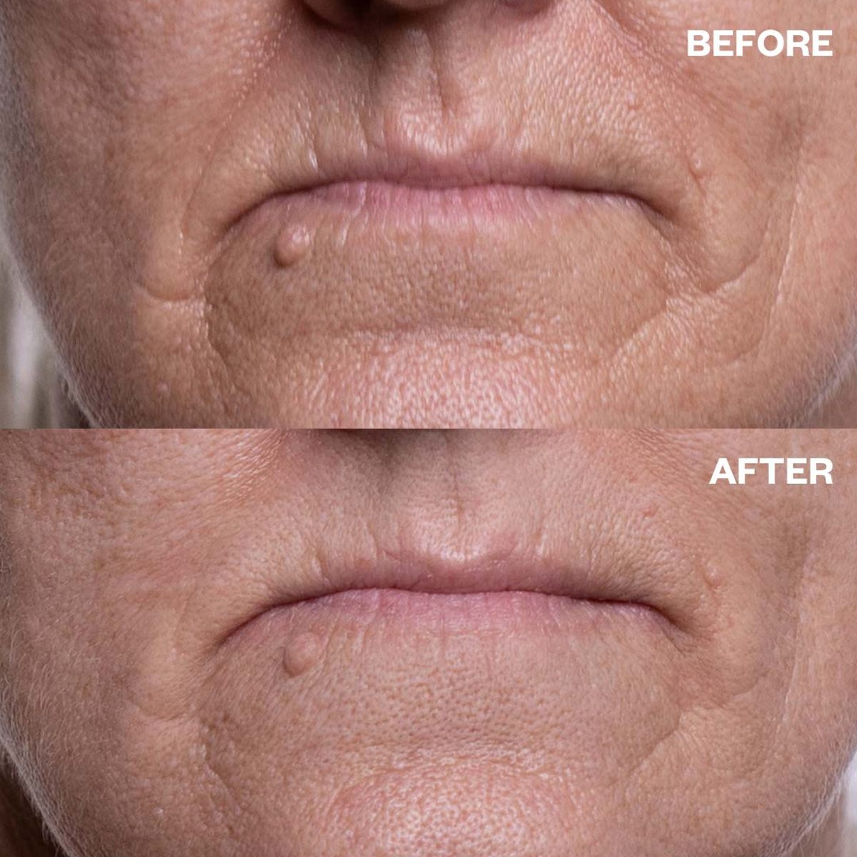 Wrinkles Schminkles Mouth & Lip Wrinkle Patch (1 pc) - product before and afters shown. 