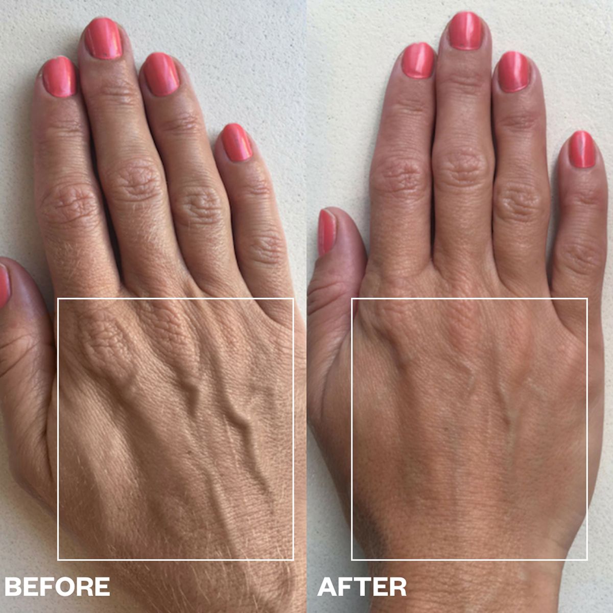 Wrinkles Schminkles Hand Wrinkle Patches (2 pcs) - product before and afters shown.