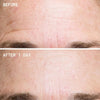 Wrinkles Schminkles Forehead Wrinkle Patches (2 pcs) - product before and afters shown. 