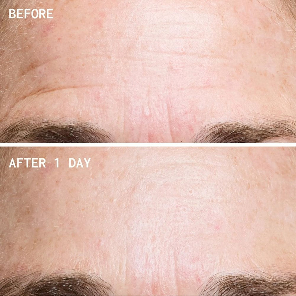 Wrinkles Schminkles Forehead Wrinkle Patches (2 pcs) - product before and afters shown. 