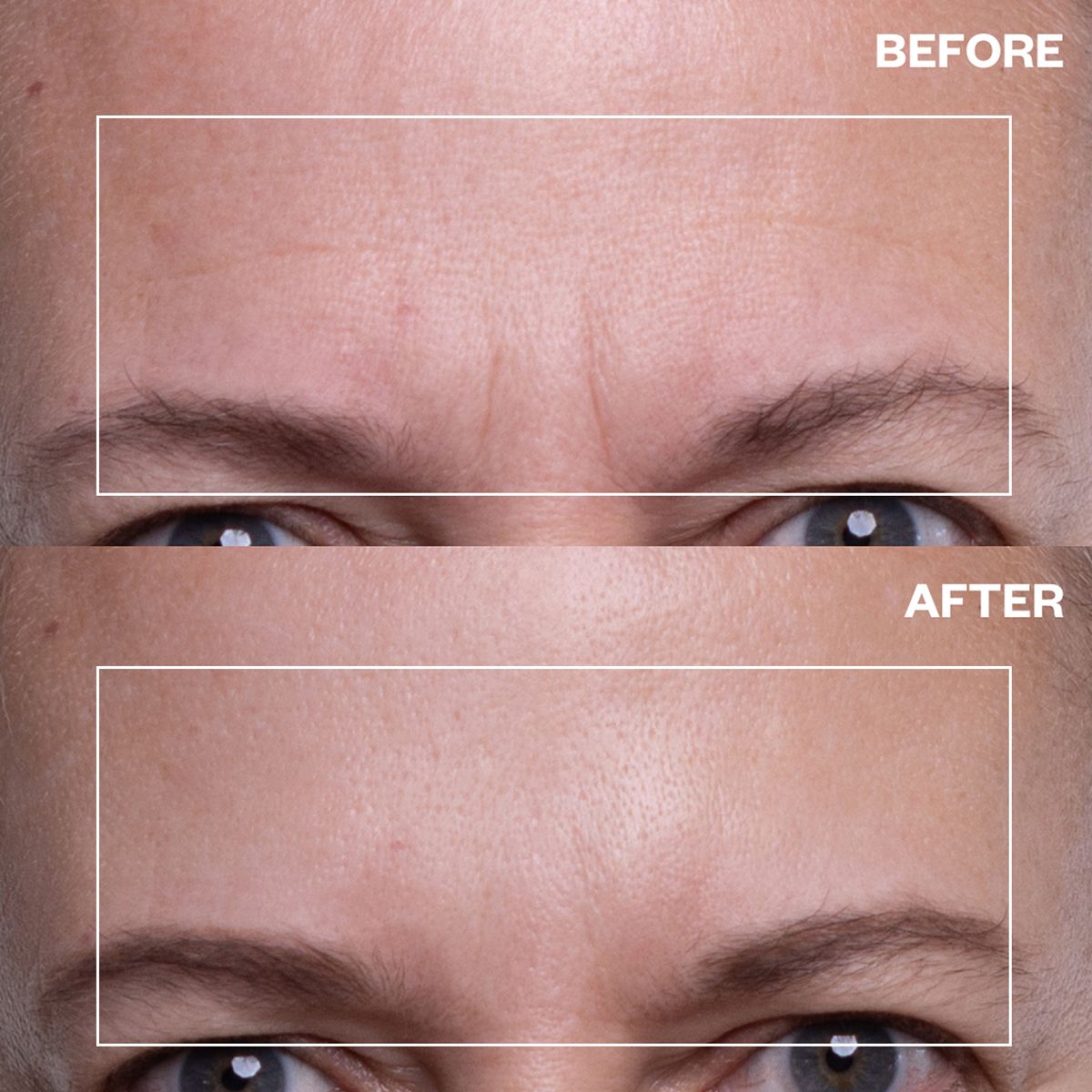 Wrinkles Schminkles Forehead Wrinkle Patches (2 pcs) - product before and afters shown. 