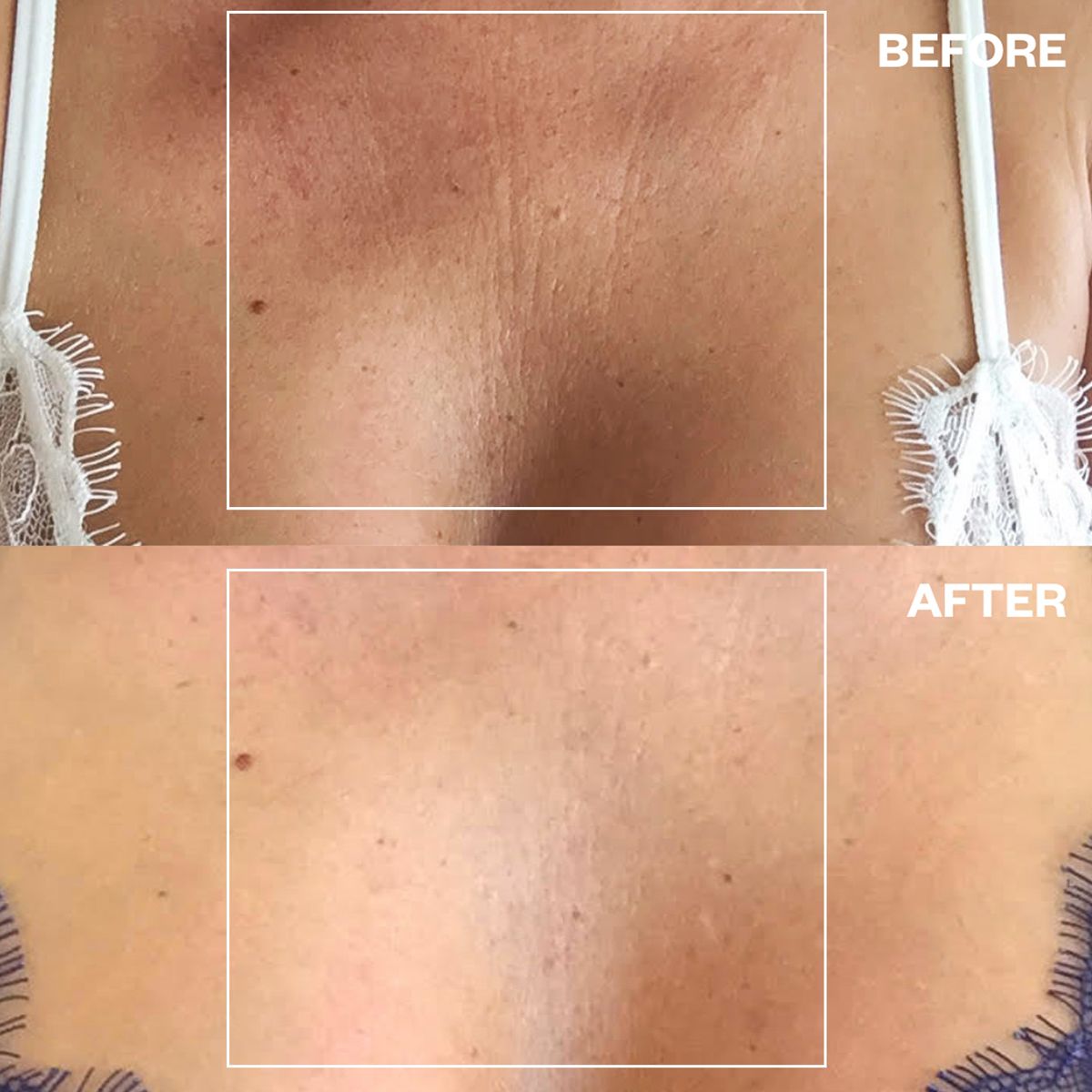 Wrinkles Schminkles Chest Wrinkle Patch (1 pc) - product before and afters shown. 