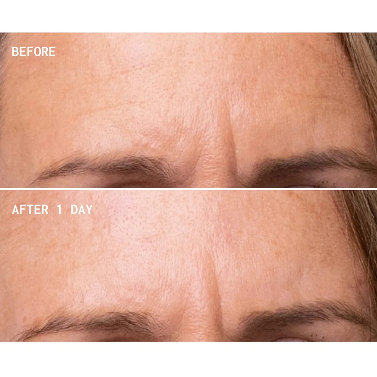 Wrinkles Schminkles Face, Neck &amp; Decolletage Peel Pads (5 pcs) - before and after pictures of forehead