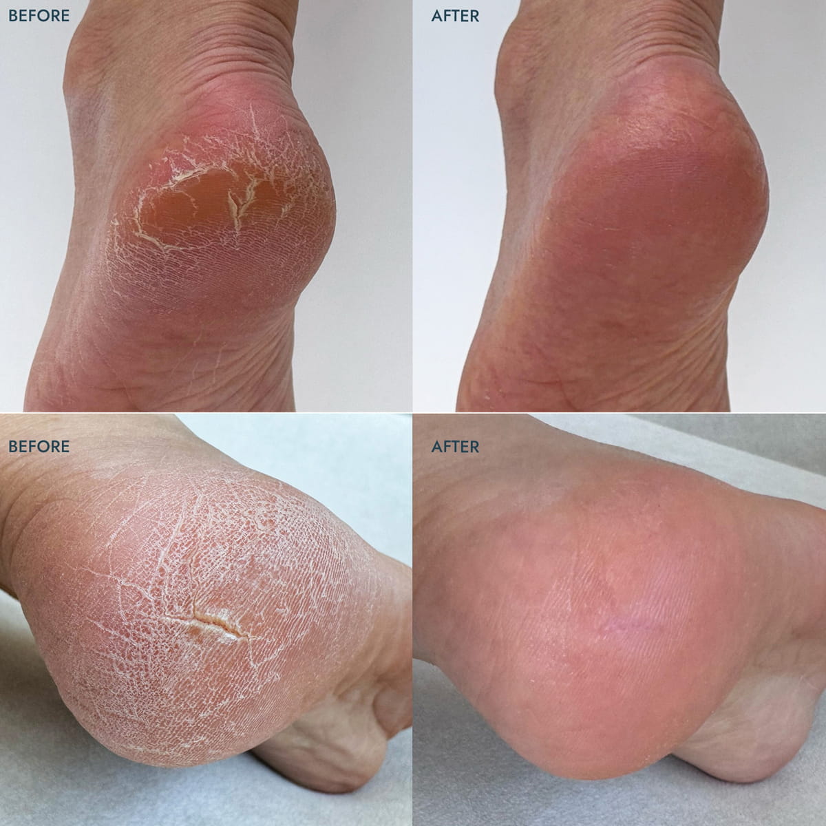 Before and after use of VOESH New York Heel Repair Duo - Lavender (2 pcs). A 2x2 before-and-after collage showing the heel of a foot with dry, cracked skin in the top-left and top-right panels, and smooth, healed skin in the bottom-left and bottom-right panels. The words BEFORE and AFTER appear in the corners.