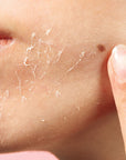 close-up of a woman's peeling face before using this product.