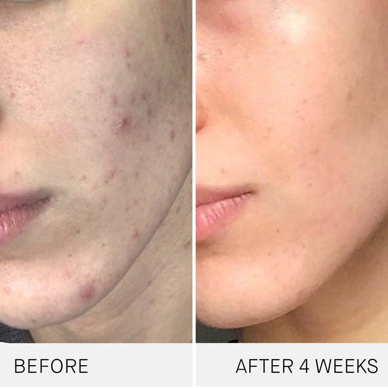 Before and after shot of model using Augustinus Bader The Cream after 4 weeks