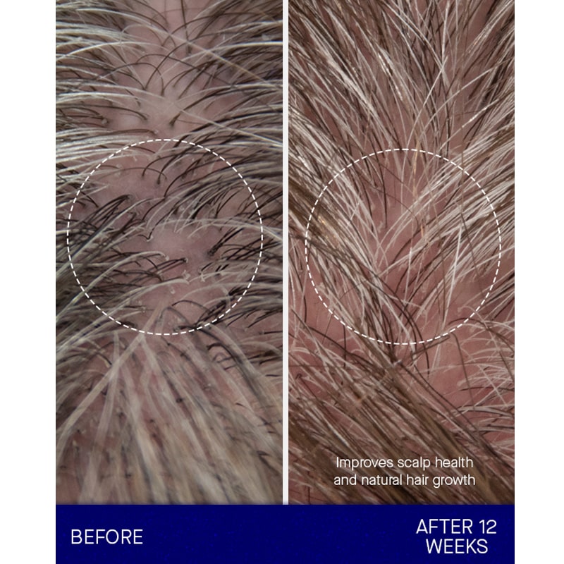 Augustinus Bader The Conditioner showing a before and after 12 weeks of using conditioner
