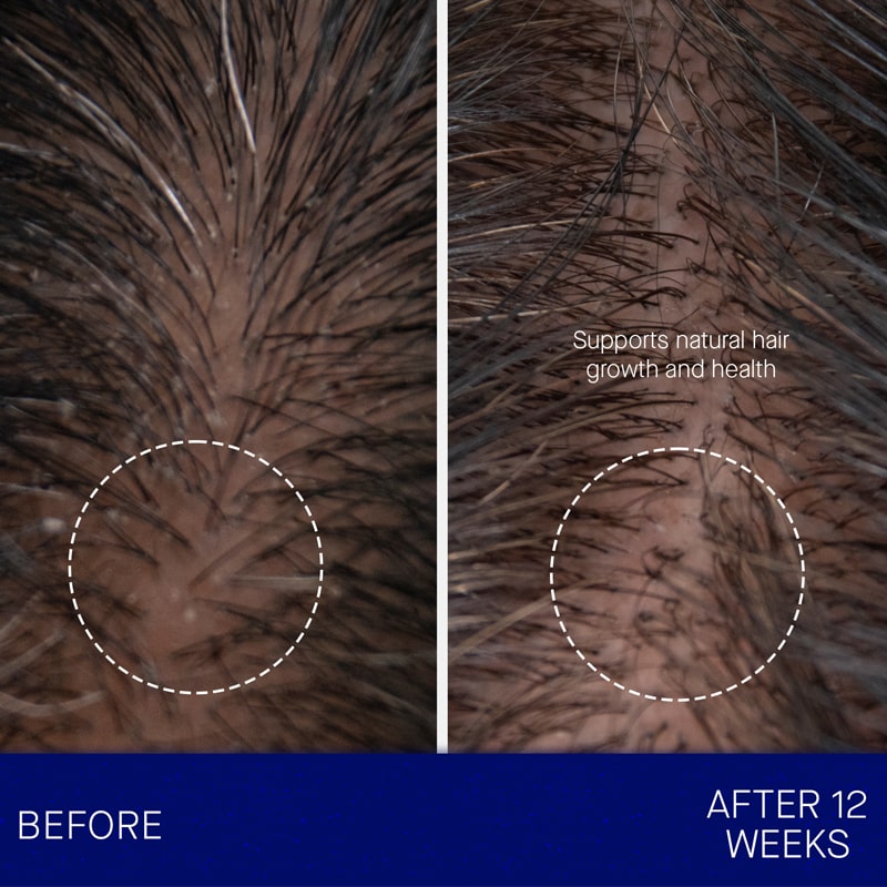 Augustinus Bader The Leave In Hair Treatment showing before and after