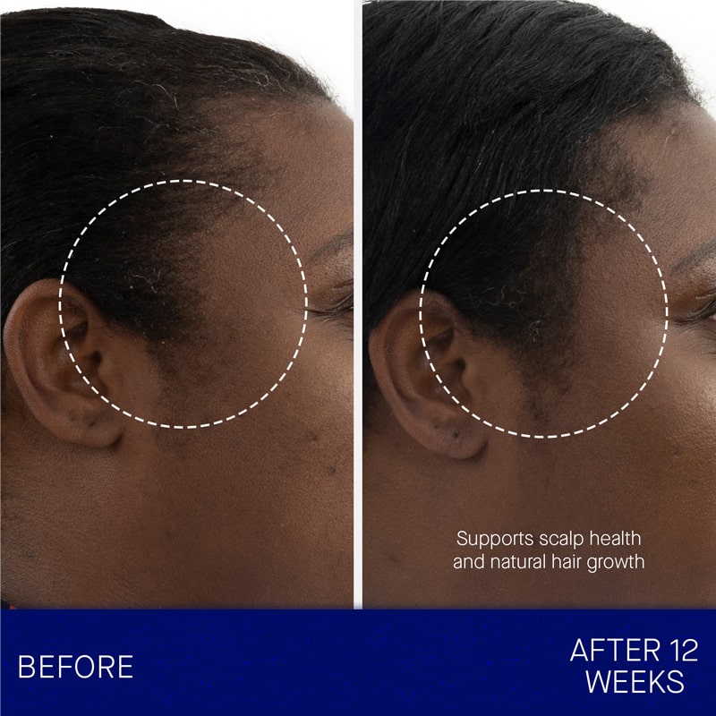 Augustinus Bader The Scalp Treatment showing before and after