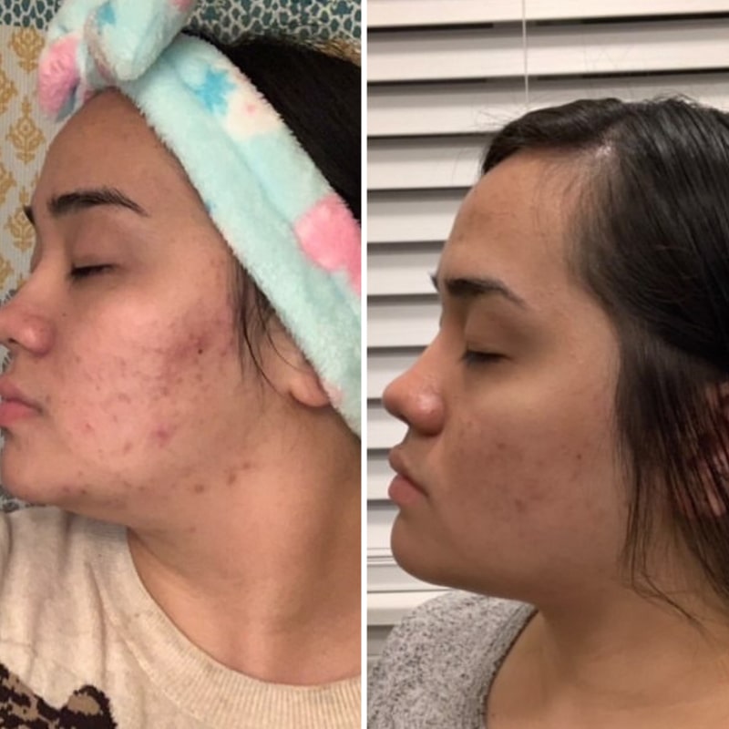 Clean Skin Club Clean Towels shown with model&#39;s before and after face